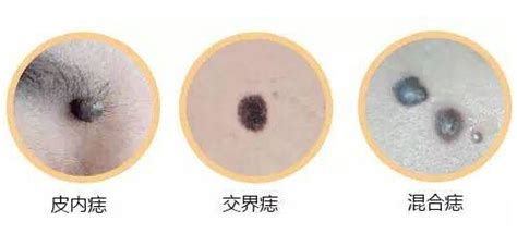 痣太多|痣變大、痣多或長毛會變皮膚癌？認識痣的形成與原因